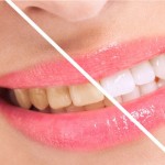 Smile teeth will shine better, 7 effective ways to whiten teeth